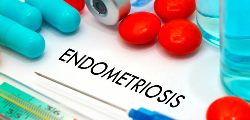 Endometriosis affects more than 6.5 million women in the United States and is often treated with hormonal therapies that can cause side effects, reduce fertility or be ineffective. (Credit: Natal’ya Buzuevskaya | Dreamstime.com)